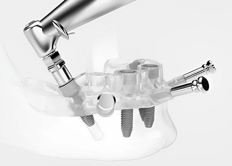 Implantes Guiados por IA 2